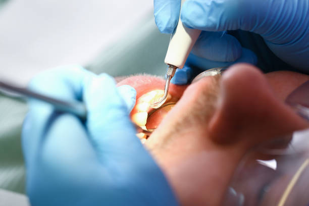 Best Knocked-Out Tooth (Avulsed Tooth) Treatment in Pine Bush, NY